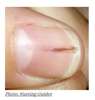 unha estria vermelha