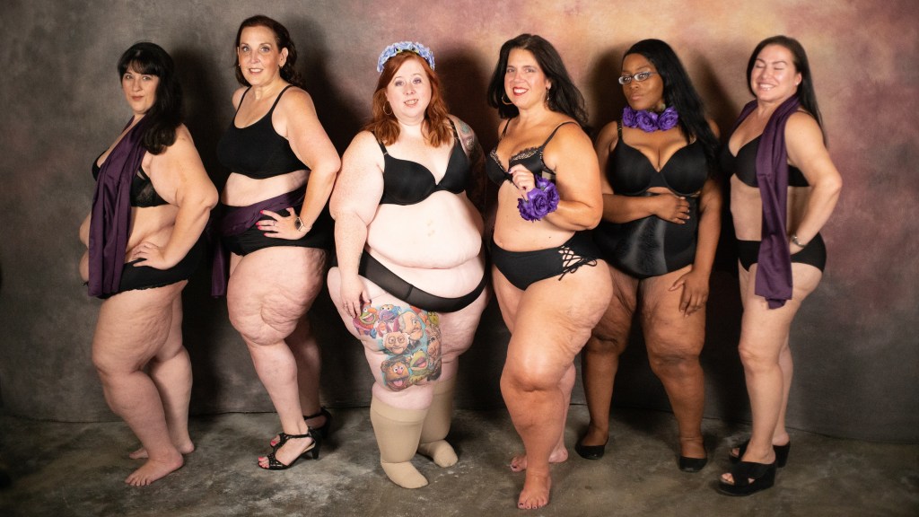 Lipedema: parece celulite, mas não é e atinge 5 milhões de mulheres