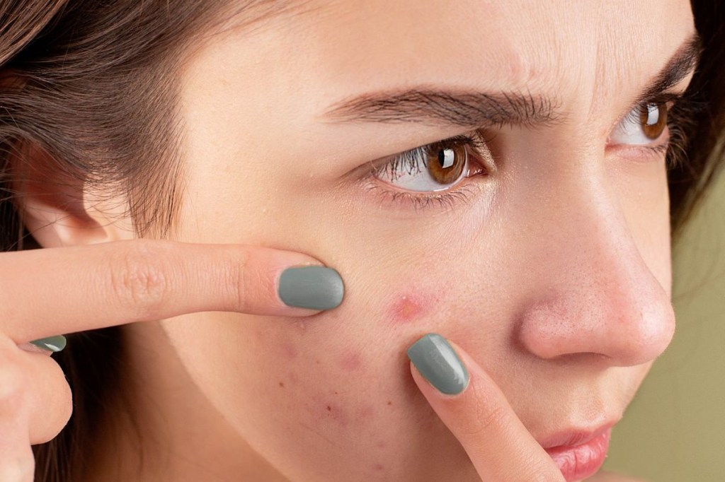 Acne x saúde mental: quais são as consequências psicológicas do problema?