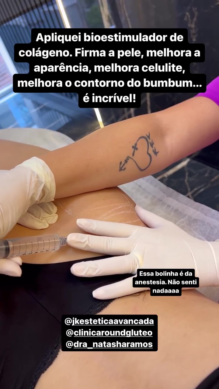 karoline lima Karoline Lima fazendo aplicação de bioestimuladores de colágeno