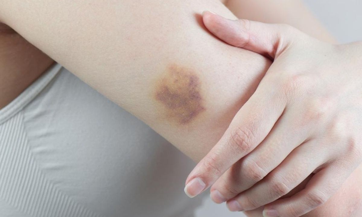 hematomas