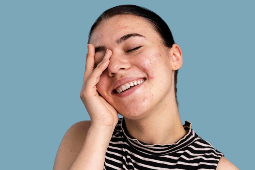 Como cuidar da pele acneica no verão: confira dicas de profissionais