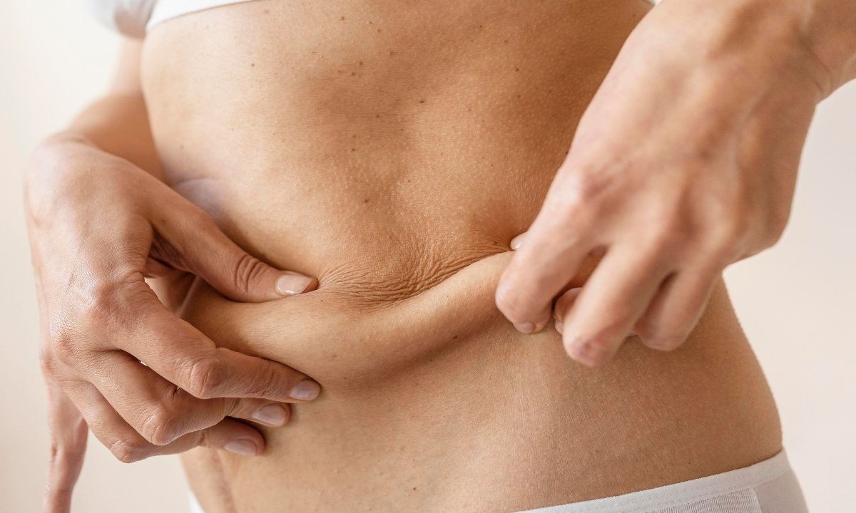 lipoaspiração pode deixar a pele flácida