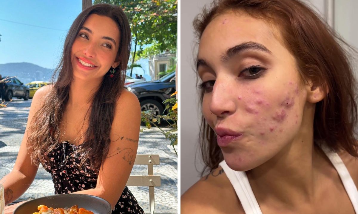 Vanessa Lopes mostra acne após um mês de tratamento com Roacutan