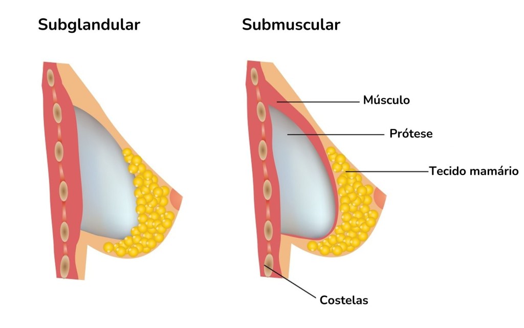 Subglandular .