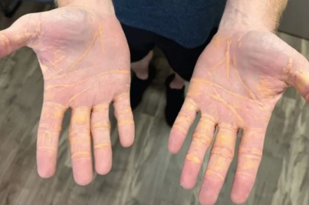 Colesterol ‘vaza’ pela pele de homem que fazia dieta carnívora