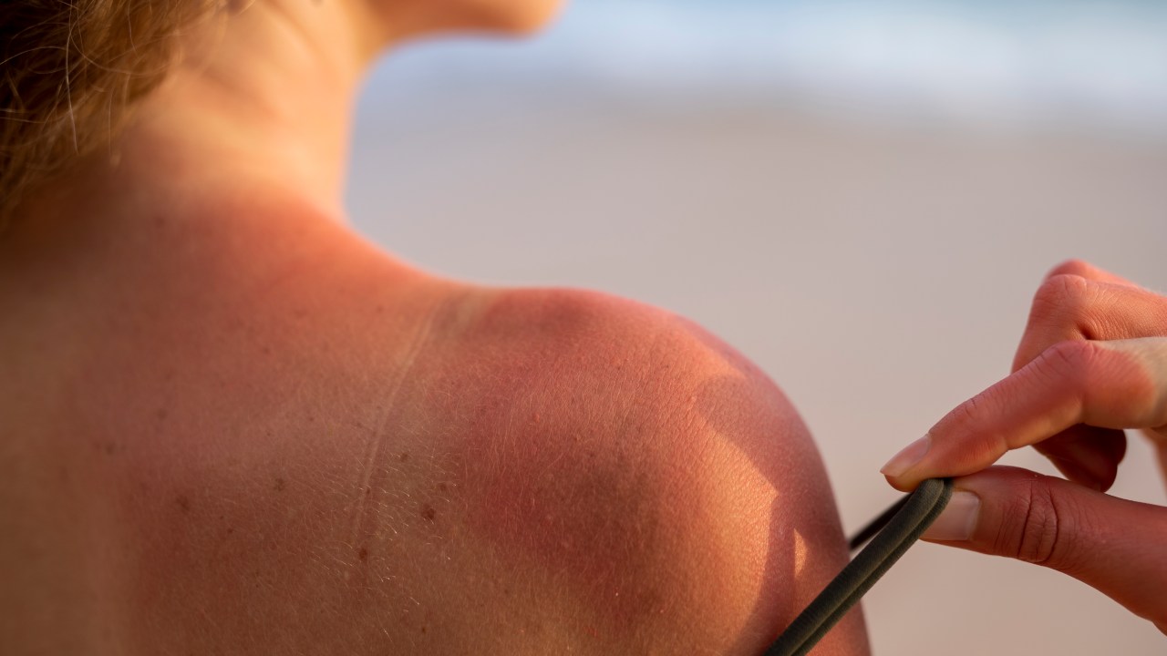 Veja formas de evitar as queimaduras de sol neste verão