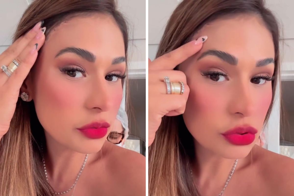 Simone Mendes mostra cicatriz na testa