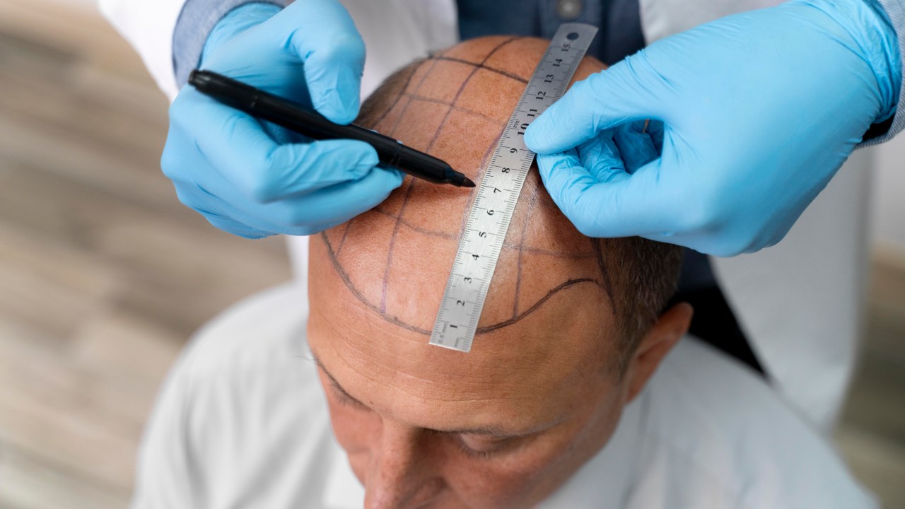 Confira como é feito e quais são os riscos do transplante capilar